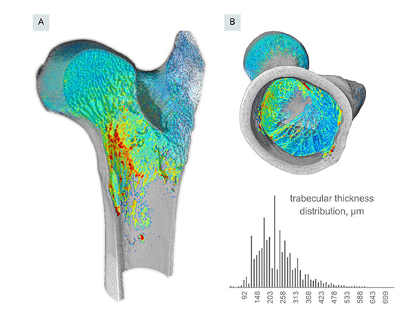 Quantitative analysis of trabecular thickness using the volume-thickness mapping method. Panels A and B show different virtual sections of the interior of the metaphysis. A histogram is shown in the inset. Note the general homogeneity of the strut thicknesses within the trabecular fabric. The centre of the thickness distribution is around 200- 260 μm, which is fairly close to the computed Tb.Th mean of 256 μm.